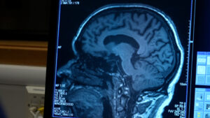 ABD, 20 yıl sonra birinci kere yeni bir Alzheimer ilacını onayladı