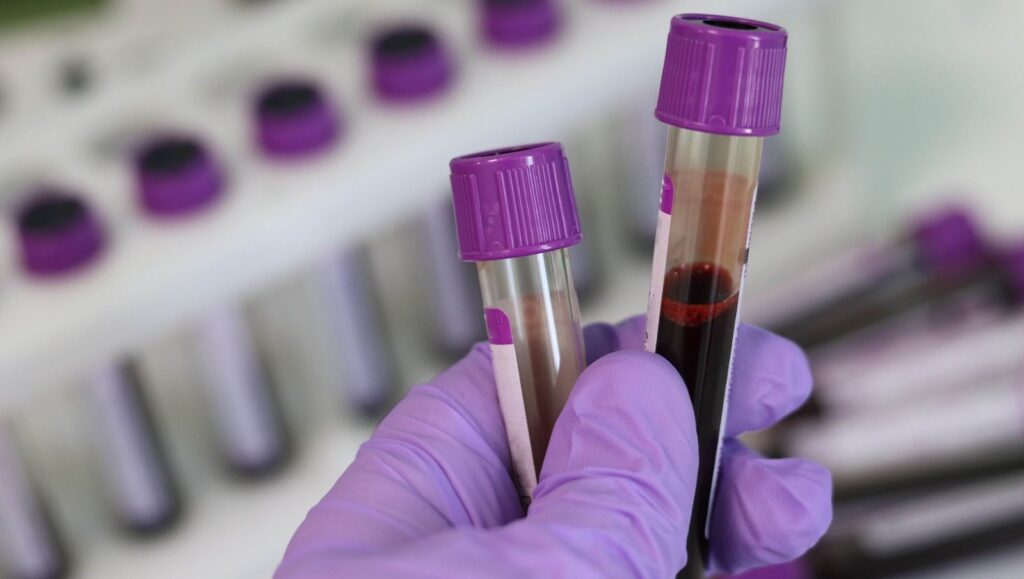Araştırma: 50 kanser cinsini hakikat tespit eden kan testi yüzde 88,7 başarılı oldu