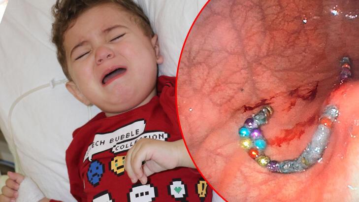 19 aylık Murat’ın midesinden 17 boncuk mıknatıs çıkarıldı