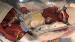 648 gram doğan Umut bebek hayata tutunmayı başardı!