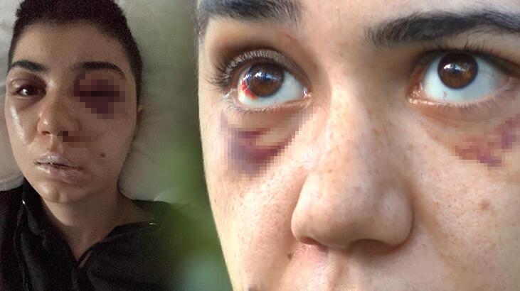 Her şey nişan yemeğine gitmesiyle başladı! Beyoğlu’nda genç kadını felç eden dayak