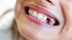 Süt dişi travmalarına dikkat