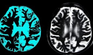 AB, Alzheimer tedavisi için geliştirilen ilaca kullanım onayı vermedi