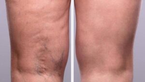 Ameliyat olmadan varislerden kurtulmanın yolu! 15 dakika sürüyor