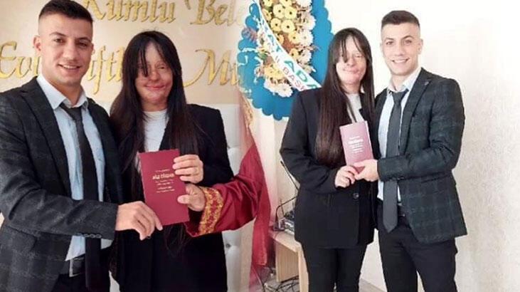 Berfin, yüzüne asit atan eski erkek arkadaşıyla evlendi! Babasından ilk açıklama