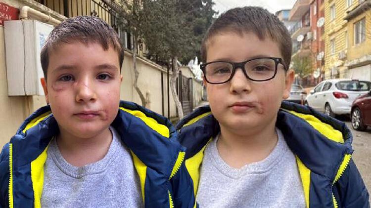 Köpek saldırısı sonrası yüzüne 60 dikiş atılan Mert, günler sonra sokağa çıktı