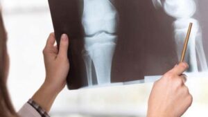 Osteoporoz neden kadınlarda daha fazla görülüyor?