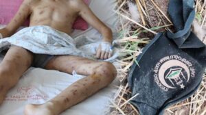 10 köpeğin saldırısına uğrayan 12 yaşındaki Enes  9 operasyon geçirdi!