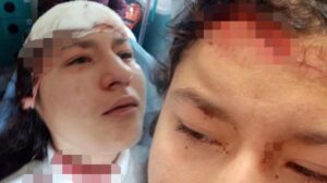 Genç kız selfie çekerken 5 köpeğin saldırısına uğradı