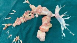 Kovid’e bağlı pıhtı sanıldı, ameliyatta ortaya çıkan gerçek doktorları bile şaşırttı