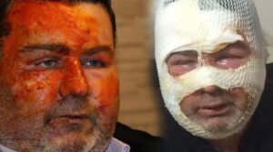 Uyurken dehşeti yaşadı! Kız kardeşi tarafından yüzünün yakıldığını iddia etti