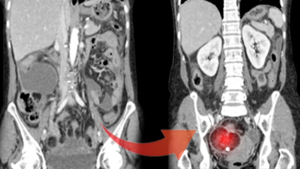 9 kiloluk tümörü görenler şaşkına döndü! Özellikle genç kadınlarda çok yaygın…