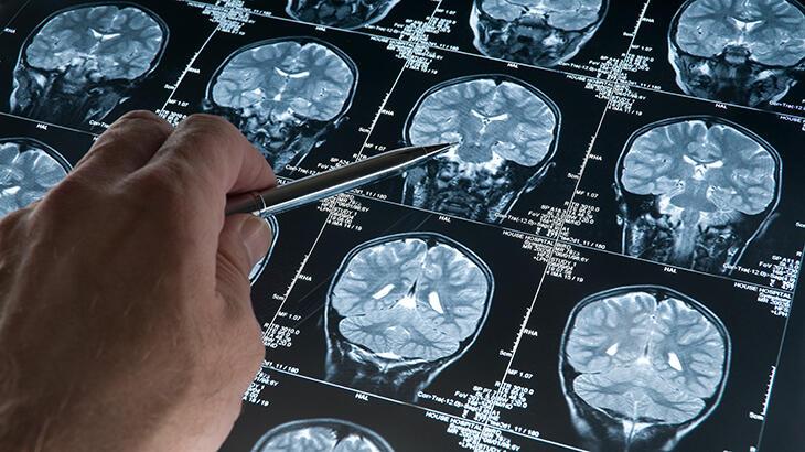 Alzheimer’da çok çarpıcı koronavirüs detayı! Sakın bu soruları sormayın