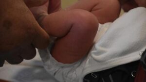 Bebeklik döneminde sünnet yaptırmak avantajlı mı, sakıncalı mı?