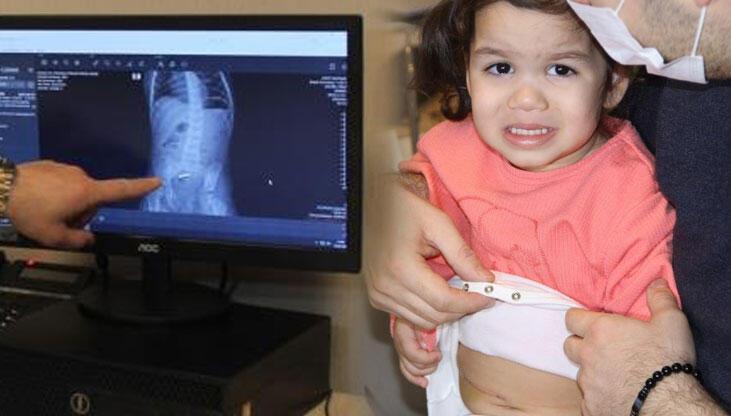 Mıknatıslı oyuncak yutan 2,5 yaşındaki Cemre ölümden döndü