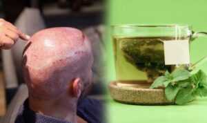 Saç ekimi yaptıracaklara ‘yeşil çay’ uyarısı