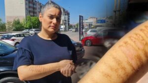 Epilasyon için gittiği güzellik merkezinde kolları yandı