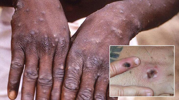 Maymun çiçeğinde 28 günlük karantina! Bilim Kurulu üyesi duyurdu