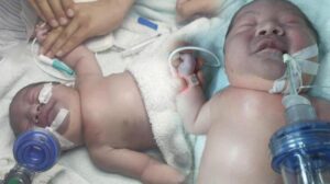 Yeni doğan bebeğin köprücük kemiği kırıldı, vücudu mosmor oldu