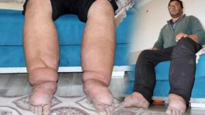 Bacakları her yıl 7 santimetre genişliyor! Milyonda bir görülüyor, tedavisi yok