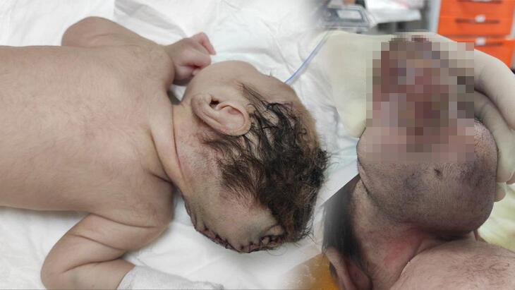 Beyni dışarıda doğan bebeği ameliyat eden doktor konuştu! ‘İki sebebi var’