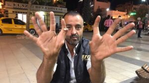 Elazığ’da 11 parmaklı adam görenleri hayrete düşürüyor