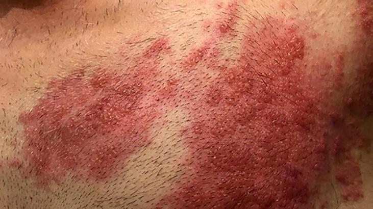 Son 10 yılda görülenden daha fazla! Zona vakalarını hortlattı