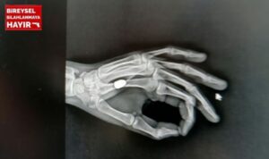 Yer Trabzon: Eline taş düştüğünü sandı, ‘yorgun mermi’ çıktı