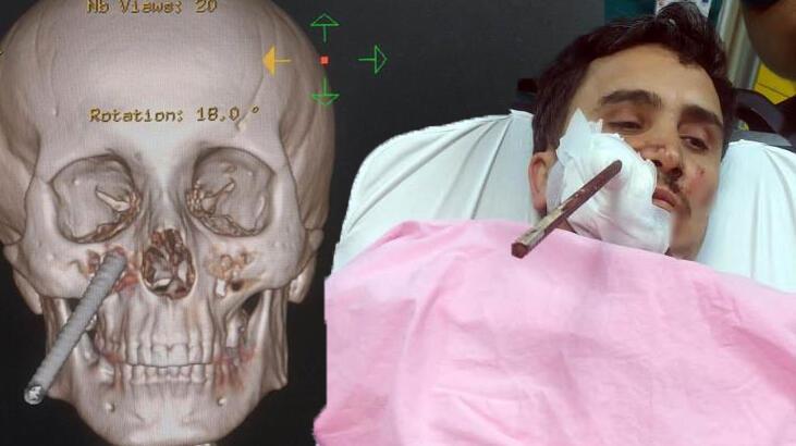 Yüzüne saplanan demirle hastaneye kaldırıldı!